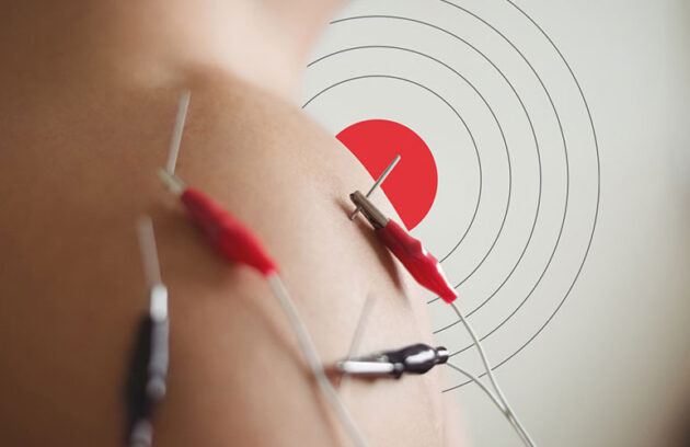 الکترواکوپانکچر یا electroacupuncture