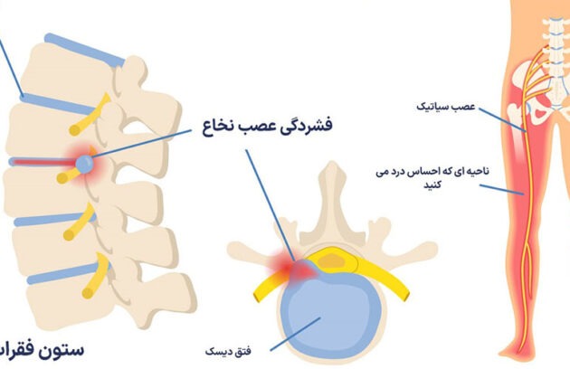 رابطه بین دیسک کمر و سیاتیک The relationship between lumbar disc and sciatica