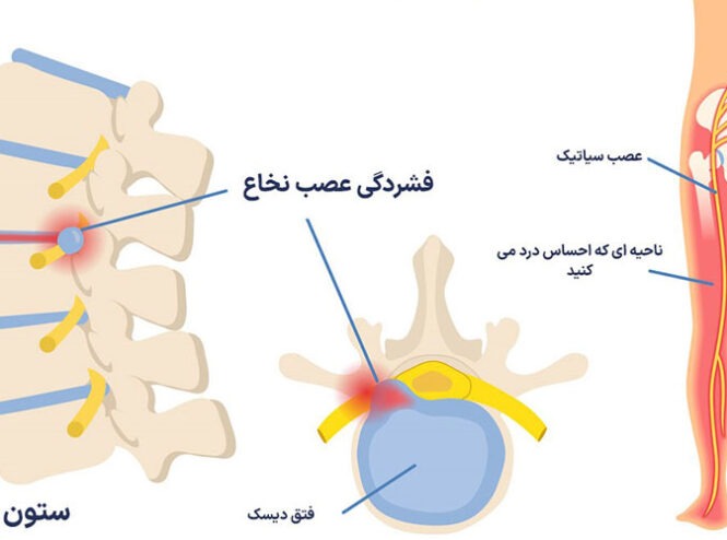 رابطه بین دیسک کمر و سیاتیک The relationship between lumbar disc and sciatica