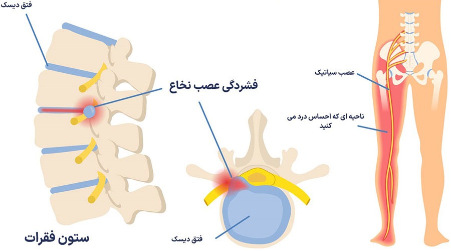 رابطه بین دیسک کمر و سیاتیک The relationship between lumbar disc and sciatica