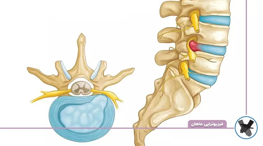 شرایط بحرانی دیسک کمر