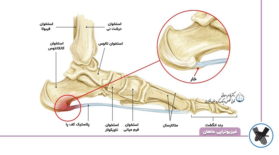 از کجا بفهمیم خار پاشنه داریم؟