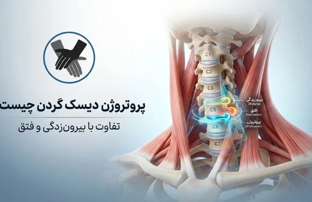 پروتروژن دیسک گردن چیست؟ [تفاوت با بیرون زدگی و فتق]