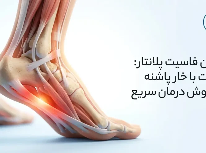 درمان فاسیت پلانتار (Plantar Fasciitis): تفاوت با خار پاشنه + 5 روش درمان سریع