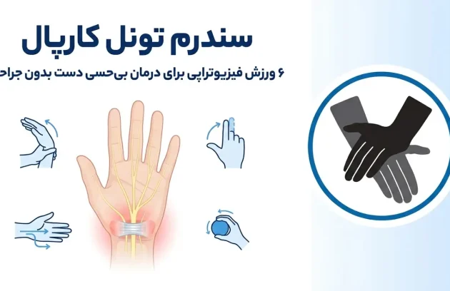 درمان سندرم تونل کارپال: 6 ورزش فیزیوتراپی برای بهل بی‌حسی دست [بدون جراحی]