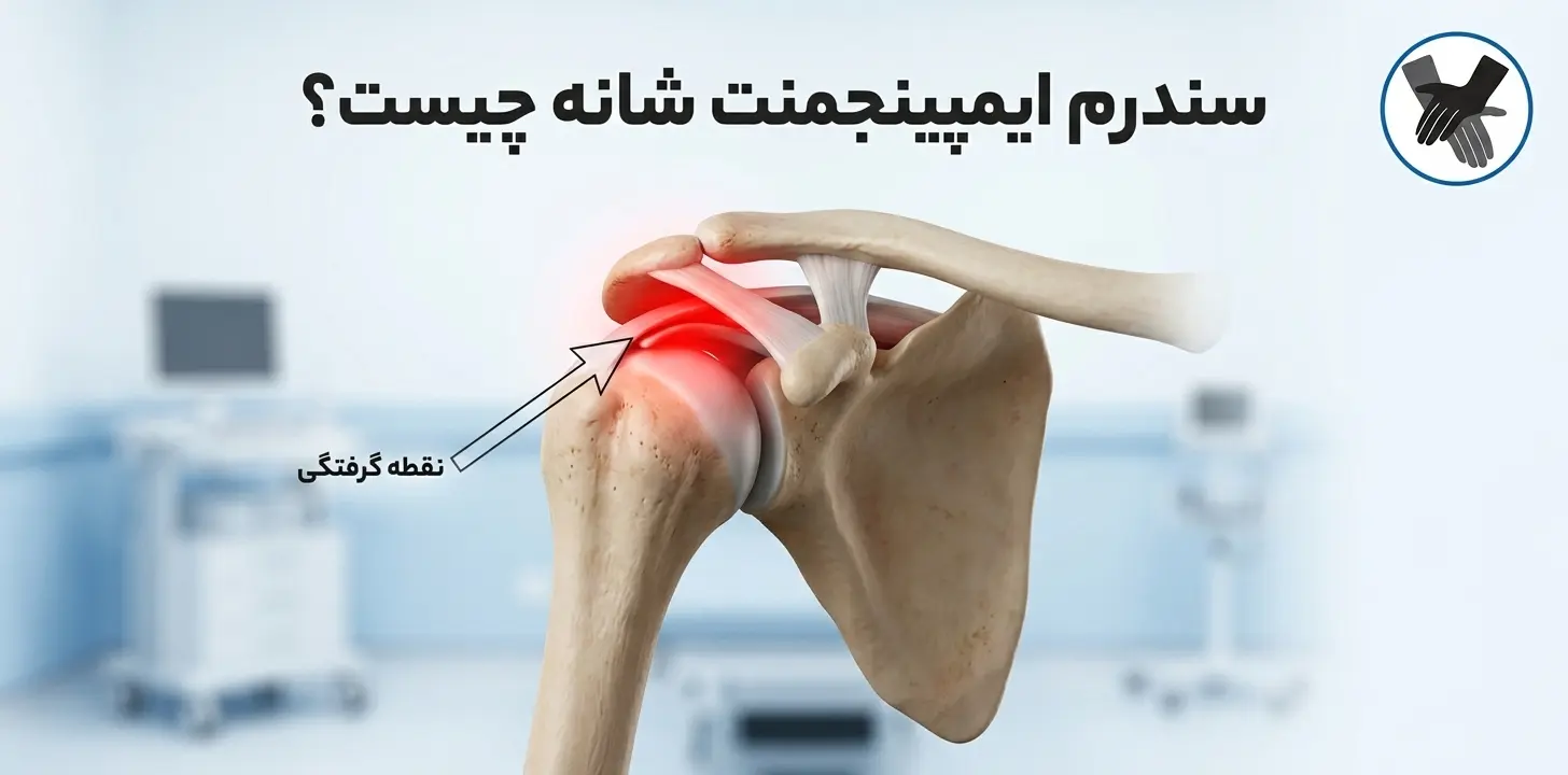 سندرم ایمپینجمنت شانه چیست؟